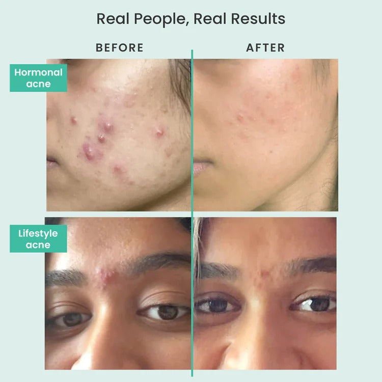 Petal Pure Acne Control Face Wash