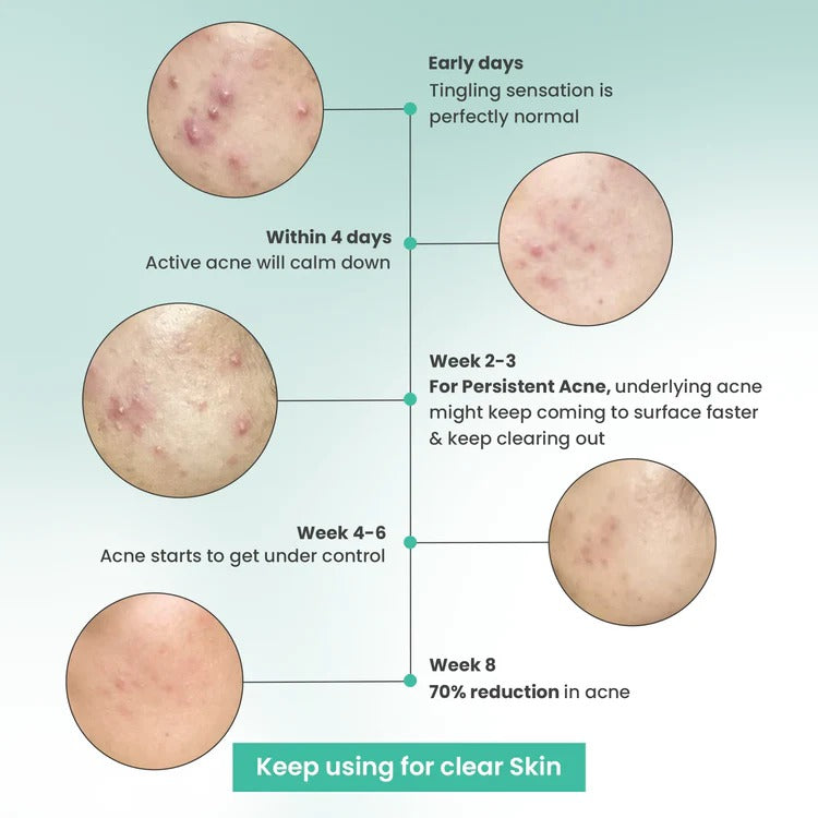 Petal Pure Acne Control Face Wash